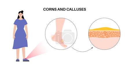 Illustration for Callus medical poster. Rough, thickened area of skin on the human feet. Dermatology clinic banner with swollen skin and painful round corns. Dead cells on epidermis level flat vector illustration - Royalty Free Image