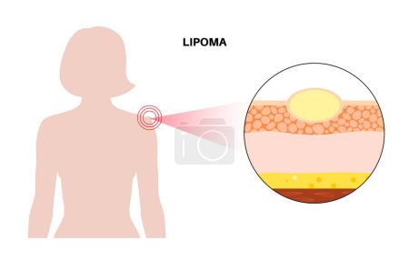 Lipoma fatty tumor medical poster. Not cancer, benign tumor under skin, fat lump in human body. Skin layers structure epidermis, dermis and hypodermis and muscle medical flat vector illustration