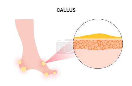Illustration for Callus medical poster. Rough, thickened area of skin on the human feet. Dermatology clinic banner with swollen skin and painful round corns. Dead cells on epidermis level flat vector illustration - Royalty Free Image