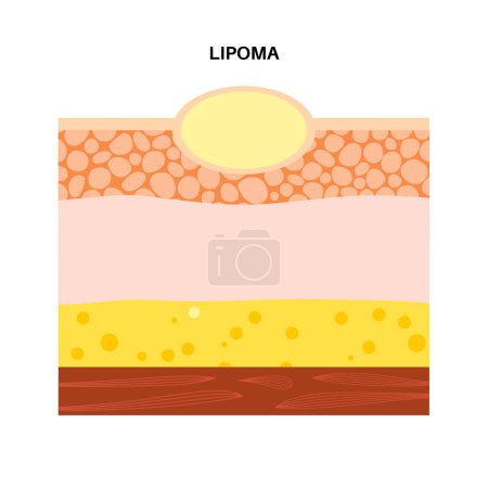 Illustration for Lipoma fatty tumor medical poster. Not cancer, benign tumor under skin, fat lump in human body. Skin layers structure epidermis, dermis and hypodermis and muscle medical flat vector illustration - Royalty Free Image