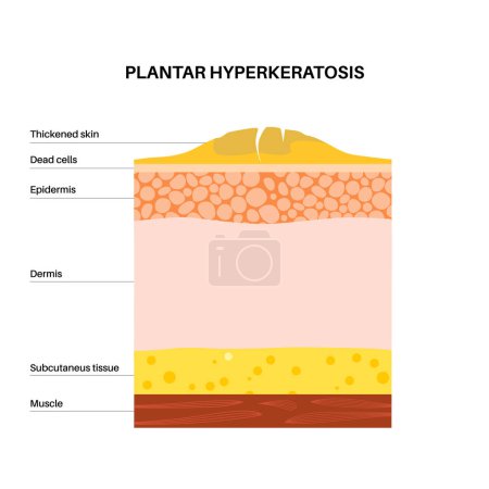 Illustration for Plantar hyperhidrosis medical poster. Rough, thickened area of skin on the human feet. Dermatology clinic banner with swollen painful skin. Dead cells on epidermis level flat vector illustration - Royalty Free Image
