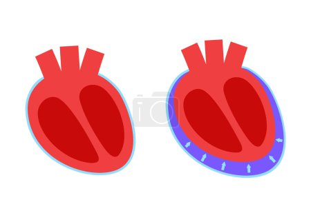 Illustration for Pericardial effusion poster. Fluid in the space around the heart, cardiac tamponade cause. Inflamed internal organs, infection in the human body. Cardiovascular system medical vector illustration - Royalty Free Image