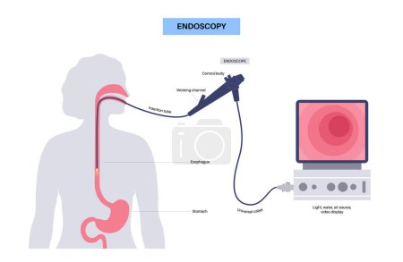 Illustration for Gastroscopy procedure. Gastroenterologist uses a gastroscope. Endoscopy, stomach diagnostic in clinic. Gastroenterology, gastrointestinal infection. Digestive tract disease and treatment flat vector - Royalty Free Image