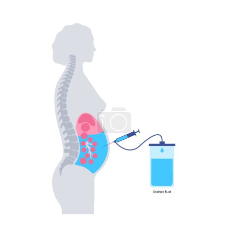 Illustration for Abdominal paracentesis procedure. Fluid in abdomen. Drain ascitic fluid for diagnostic or therapy. A needle or catheter is inserted into the peritoneal cavity. Remove excess fluid from belly vector - Royalty Free Image