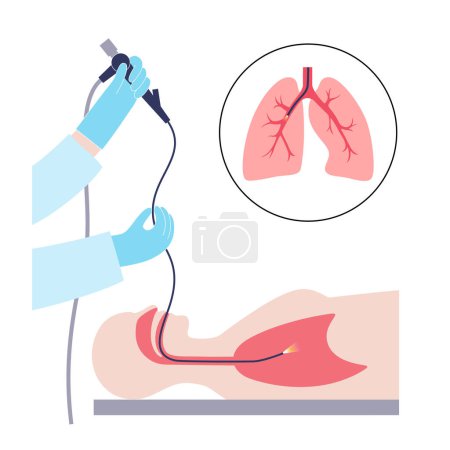 Bronchoskopie-Verfahren. Pneumologe verwendet ein Bronchoskop durch den Mund in die Lunge. Erkrankungen und Behandlung der Atemwege. Endobronchiale Ultraschall-Bronchoskopie Diagnosevektor Illustration.