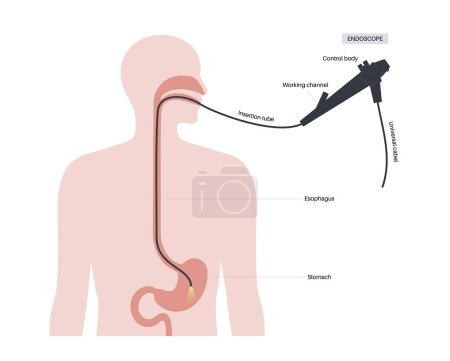 Illustration for Gastroscopy procedure. Gastroenterologist uses a gastroscope. Endoscopy, stomach diagnostic in clinic. Gastroenterology, gastrointestinal infection. Digestive tract disease and treatment flat vector - Royalty Free Image