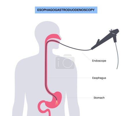 Illustration for Gastroscopy procedure. Esophagogastroduodenoscopy concept. Endoscopy, stomach diagnostic in clinic. Gastroenterology, gastrointestinal infection. Digestive tract disease and treatment flat vector - Royalty Free Image