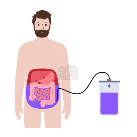 Illustration for Abdominal paracentesis procedure. Fluid in abdomen. Drain ascitic fluid for diagnostic or therapy. A needle or catheter is inserted into the peritoneal cavity. Remove excess fluid from belly vector - Royalty Free Image