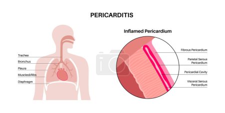 Illustration for Pericarditis anatomical poster. Heart wall inflammation. Chest pain symptom. Inflamed internal organs concept. Viral infection in the human body. Cardiovascular system medical flat vector illustration - Royalty Free Image