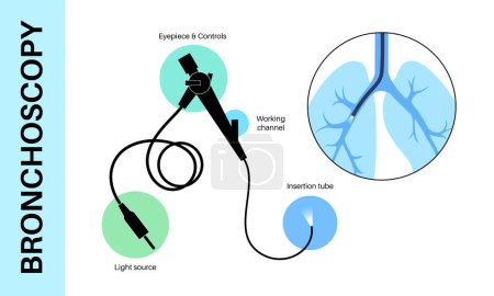 Bronchoscopy procedure. Pulmonologist uses a bronchoscope through trachea into the lung. Respiratory system diseases and treatment. Endobronchial ultrasound bronchoscopy diagnostic vector illustration