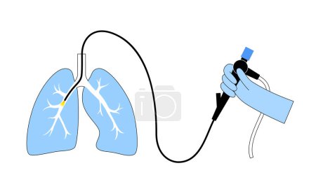 Procedimiento de broncoscopia. El neumólogo usa un broncoscopio a través de la tráquea hasta el pulmón. Enfermedades del sistema respiratorio y tratamiento. Ultrasonido endobronquial broncoscopia diagnóstico vector ilustración