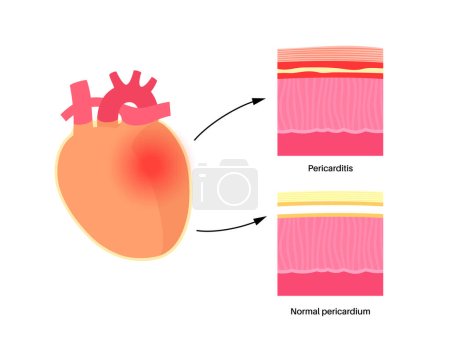 Illustration for Pericarditis anatomical poster. Heart wall inflammation. Chest pain symptom. Inflamed internal organs concept. Viral infection in the human body. Cardiovascular system medical flat vector illustration - Royalty Free Image