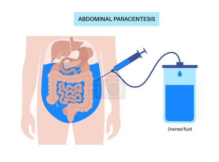 Abdominal paracentesis procedure. Fluid in abdomen. Drain ascitic fluid for diagnostic or therapy. A needle or catheter is inserted into the peritoneal cavity. Remove excess fluid from belly vector