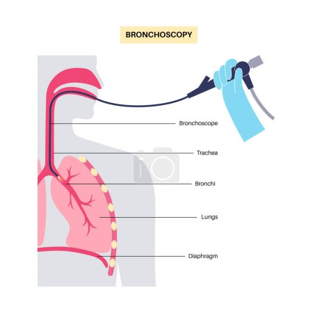Illustration for Bronchoscopy procedure. Pulmonologist uses a bronchoscope through mouth into the lung. Respiratory system diseases and treatment. Endobronchial ultrasound bronchoscopy diagnostic vector illustration. - Royalty Free Image