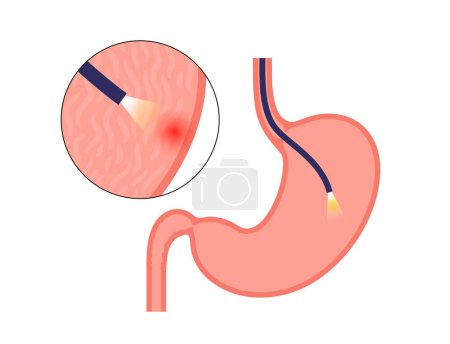 Illustration for Gastroscopy procedure. Stomach diseases diagnostic. GERD, gastritis, digestive tract inflammation. Gastroenterologist uses a gastroscope, endoscopy concept. Gastroenterology, gastrointestinal problems - Royalty Free Image