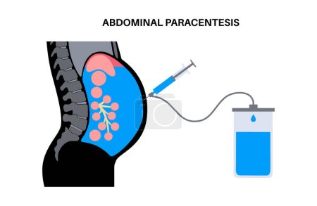 Procedimiento de paracentesis abdominal. Fluido en el abdomen. Escurrir líquido ascítico para diagnóstico o terapia. Se introduce una aguja o catéter en la cavidad peritoneal. Eliminar el exceso de líquido del vector del vientre
