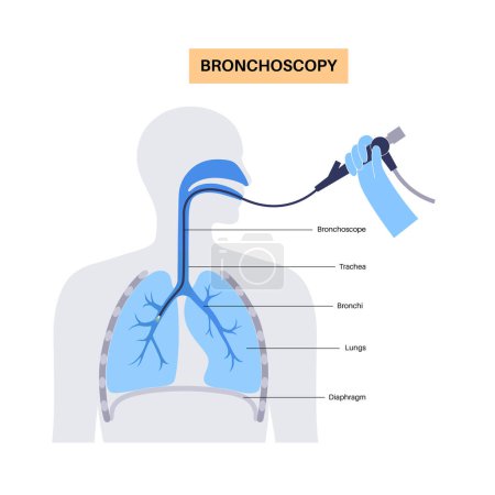 Procédure de bronchoscopie. Le pneumologue utilise un bronchoscope par la bouche jusqu'au poumon. Maladies du système respiratoire et traitement. Illustration vectorielle diagnostique de bronchoscopie par ultrasons endobronchiques.