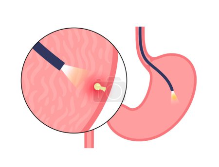 Illustration for Gastroscopy procedure. Stomach polyps diagnostic. Gastroenterologist uses a gastroscope, endoscopy concept. Gastroenterology, gastrointestinal inflammation. Digestive tract disease and treatment - Royalty Free Image
