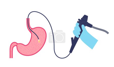 Illustration for Gastroscopy procedure. Gastroenterologist uses a gastroscope. Stomach and duodenum diagnostic. Gastroenterology, endoscopy and gastrointestinal disease. Digestive system infection and treatment vector - Royalty Free Image