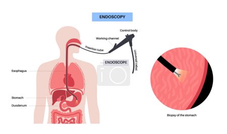 Illustration for Gastroscopy procedure. Gastroenterologist uses a gastroscope. Stomach, and intestine diagnostic. Gastroenterology, endoscopy and gastrointestinal disease. Digestive system problem and treatment vector - Royalty Free Image