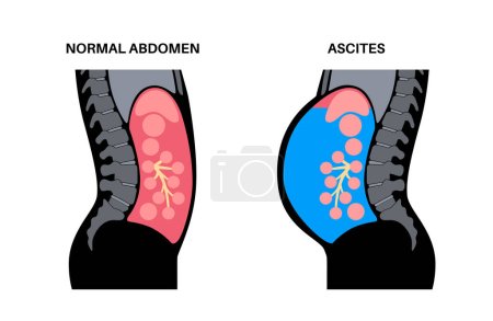 Ascites anatomy. Fluid in peritoneal cavity. Abdominal distension, pain, swelling and nausea. Pressure in belly, organs and viscera. Gastrointestinal tract. Abdominopelvic cavity vector illustration