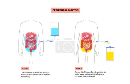 Ilustración de Procedimiento de diálisis peritoneal. Fluido en la cavidad peritoneal. Peritoneo en el abdomen, las sustancias se intercambian con la sangre. Tubo blando en el cuerpo humano, concepto de catéter. Retire el exceso de líquido del vientre - Imagen libre de derechos