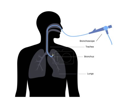 Procedimiento de broncoscopia. El neumólogo usa un broncoscopio a través de la boca hasta el pulmón. Enfermedades del sistema respiratorio y tratamiento. Ultrasonido endobronquial broncoscopia diagnóstico vector ilustración.
