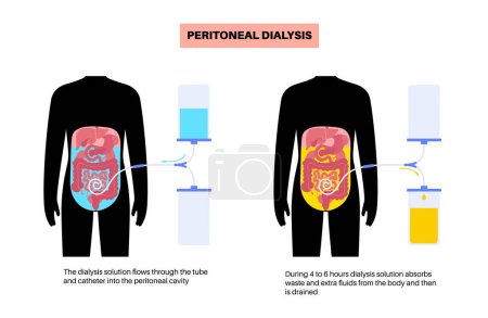 Procedimiento de diálisis peritoneal. Fluido en la cavidad peritoneal. Peritoneo en el abdomen, las sustancias se intercambian con la sangre. Tubo blando en el cuerpo humano, concepto de catéter. Retire el exceso de líquido del vientre