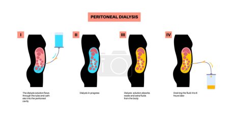 Illustration for Peritoneal dialysis procedure. Fluid in peritoneal cavity. Peritoneum in the abdomen, substances are exchanged with blood. Soft tube in human body, catheter concept. Remove excess fluid from belly - Royalty Free Image