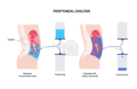 Illustration for Peritoneal dialysis procedure. Fluid in peritoneal cavity. Peritoneum in the abdomen, substances are exchanged with blood. Soft tube in human body, catheter concept. Remove excess fluid from belly - Royalty Free Image