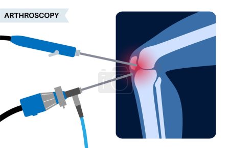 Arthroscopy medical procedure. Knee joint minimally invasive surgery. Arthroscope and arthroscopic instrument. Patella replacement, leg injury, kneecap reconstruction. Ligament and meniscus vector.