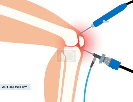 Artroscopia procedimiento médico. Cirugía mínimamente invasiva de la rodilla. Artroscopio e instrumento artroscópico. Reemplazo de rótula, lesión en la pierna, reconstrucción de rótula. Vector de ligamento y menisco.