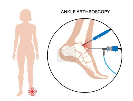 Sprunggelenksarthroskopie. Fußgelenk minimalinvasives chirurgisches Konzept. Arthroskop und arthroskopisches Instrument. Fußbehandlung, Beinschmerzen und Entzündungen. Anatomische Darstellung des Röntgenvektors