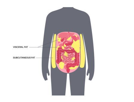 Ilustración de Cartel médico de grasa visceral. La grasa del vientre rodea los órganos internos de la cavidad abdominal. Concepto de sobrepeso. Perder peso, liposucción y dieta. Obesidad silueta humana vector plano ilustración - Imagen libre de derechos