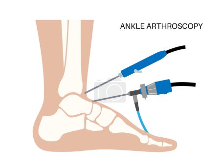 Illustration for Ankle arthroscopy procedure. Feet joint minimally invasive surgery concept. Arthroscope and arthroscopic instrument. Foot treatment, leg pain and inflammation. Anatomical x ray vector illustration - Royalty Free Image
