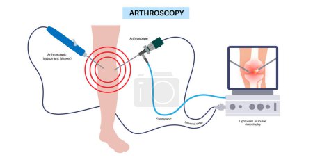 Arthroscopy medical procedure. Knee joint minimally invasive surgery. Arthroscope and arthroscopic instrument. Patella replacement, leg injury, kneecap reconstruction. Ligament and meniscus vector.