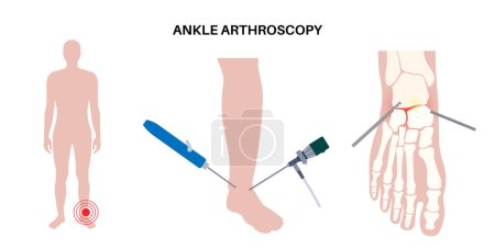 Ankle arthroscopy procedure. Feet joint minimally invasive surgery concept. Arthroscope and arthroscopic instrument. Foot treatment, leg pain and inflammation. Anatomical x ray vector illustration