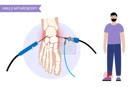 Illustration for Ankle arthroscopy procedure. Feet joint minimally invasive surgery concept. Arthroscope and arthroscopic instrument. Foot treatment, leg pain and inflammation. Anatomical x ray vector illustration - Royalty Free Image