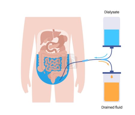 Ilustración de Procedimiento de diálisis peritoneal. Fluido en la cavidad peritoneal. Peritoneo en el abdomen, las sustancias se intercambian con la sangre. Tubo blando en el cuerpo humano, concepto de catéter. Retire el exceso de líquido del vientre - Imagen libre de derechos