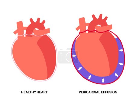 Cartel de derrame pericárdico. Líquido en el espacio alrededor del corazón, causa taponamiento cardíaco. Órganos internos inflamados, infección en el cuerpo humano. Sistema cardiovascular ilustración del vector médico