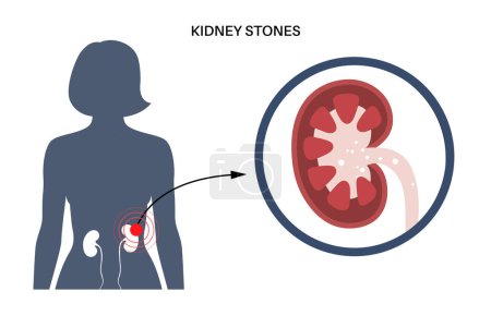 Illustration for Kidney stones treatment. Extracorporeal shock wave lithotripsy. Non invasive alternative to surgery procedure. ESWL concept. Sand like fragments pass out of the body in urine flat vector illustration - Royalty Free Image