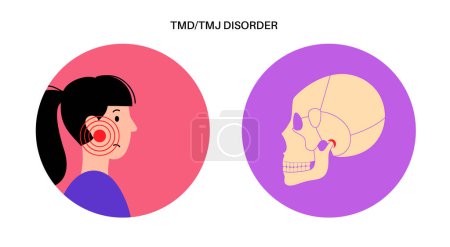 Temporomandibular joint disorder. TMD or TMJ dysfunction. Pain in the jaw joint, temporal bone locking or displaced disc. Transcutaneous electrical nerve stimulation. Human skull and mandible vector