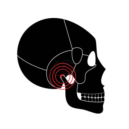 Illustration for Temporomandibular joint disorder. TMD or TMJ dysfunction. Pain in the jaw joint, temporal bone locking or displaced disc. Transcutaneous electrical nerve stimulation. Human skull and mandible vector - Royalty Free Image