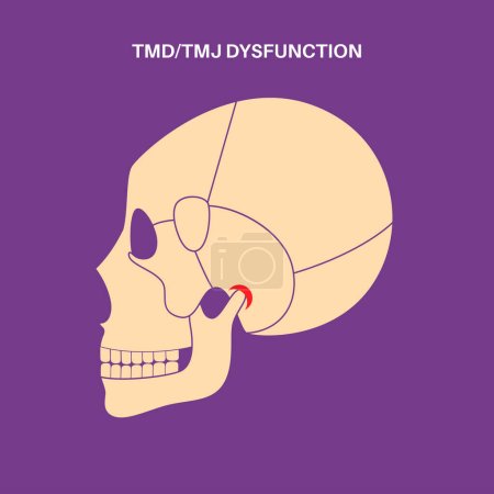 Illustration for Temporomandibular joint disorder. TMD or TMJ dysfunction. Pain in the jaw joint, temporal bone locking or displaced disc. Transcutaneous electrical nerve stimulation. Human skull and mandible vector - Royalty Free Image