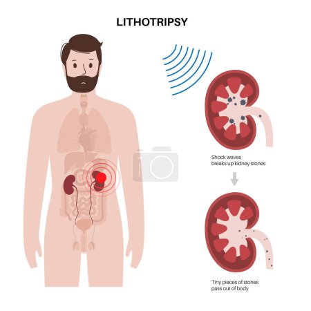 Illustration for Kidney stones treatment. Extracorporeal shock wave lithotripsy. Non invasive alternative to surgery procedure. ESWL concept. Sand like fragments pass out of the body in urine flat vector illustration - Royalty Free Image