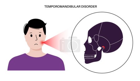 Temporomandibular joint disorder. TMD or TMJ dysfunction. Pain in the jaw joint, temporal bone locking or displaced disc. Transcutaneous electrical nerve stimulation. Human skull and mandible vector
