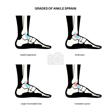 Illustration for Sprained ankle grades. Twisted feet, pain and swelling. Tears, stretch or rupture of ligaments. Foot trauma anatomical poster, diagnosis and treatment in clinic. Leg injury, X ray vector illustration - Royalty Free Image
