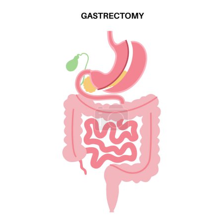 Illustration for Vertical sleeve gastrectomy. Stomach surgery, weight loss gastric procedure. Laparoscopy operation concept. Overweight problem in human body. Flat vector medical illustration for clinic or education - Royalty Free Image