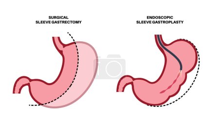 Endoscopic sleeve gastroplasty and gastrectomy operation. Stomach surgery, weight loss gastric procedure. Laparoscopy concept. Overweight problem in human body flat vector medical illustration
