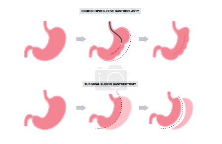 Illustration for Endoscopic sleeve gastroplasty and gastrectomy operation. Stomach surgery, weight loss gastric procedure. Laparoscopy concept. Overweight problem in human body flat vector medical illustration - Royalty Free Image
